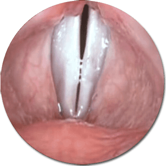 Endoscopy of vocal cords in strobe light